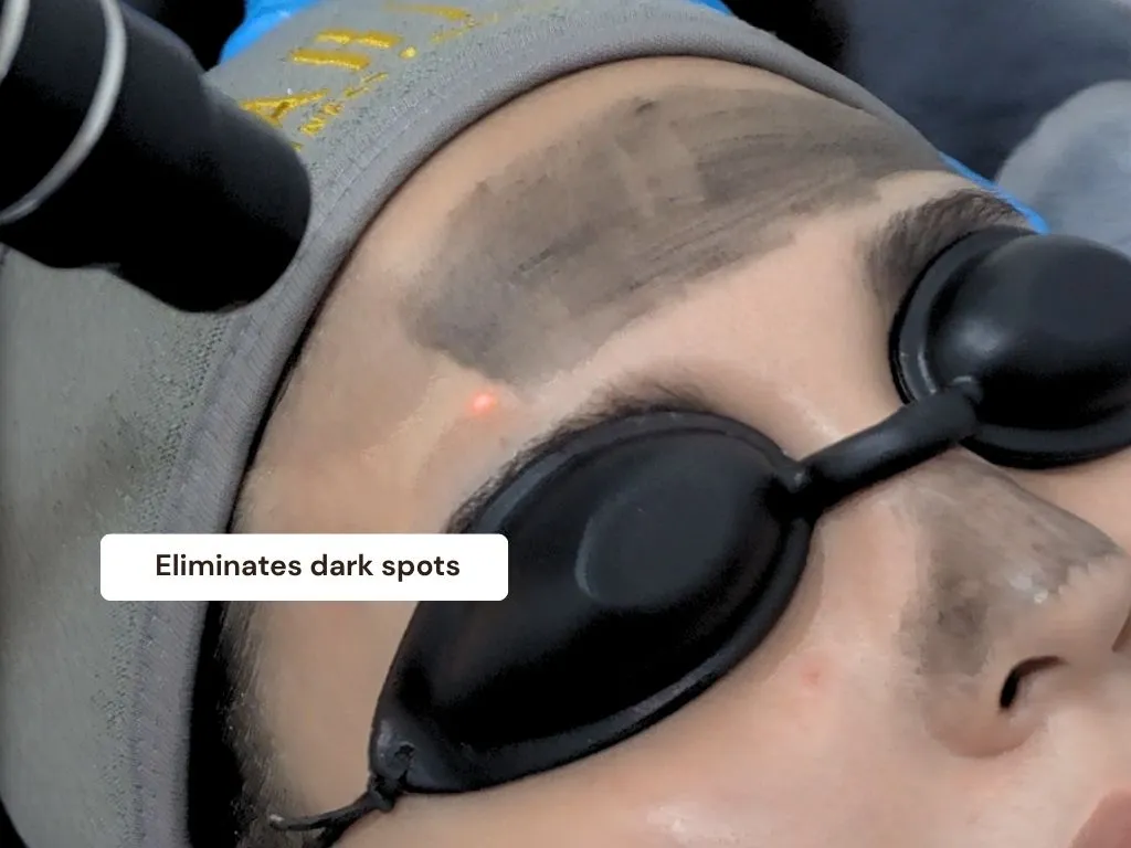 Carbon Laser detail